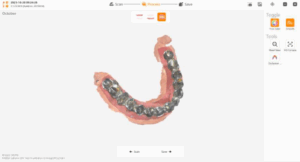 Intraoral Scanner - Prosthodontics Scan view